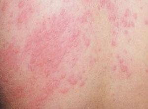 湿疹患者吃葫芦瓜,天然食疗的神奇疗效